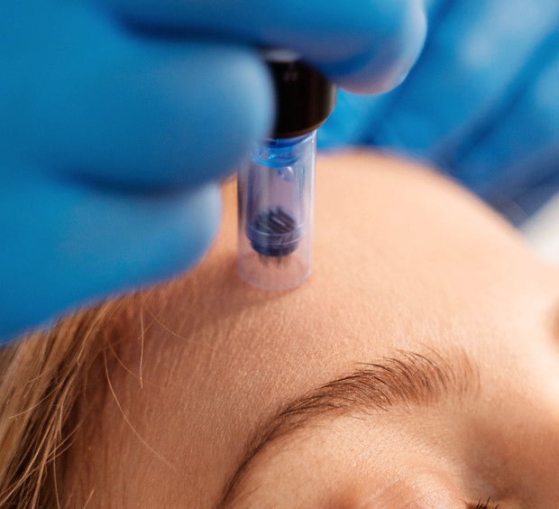 Microneedling Behandlung bei bareSkin